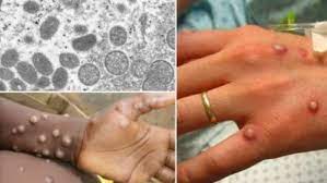 #குரங்கம்மை #newsintamil