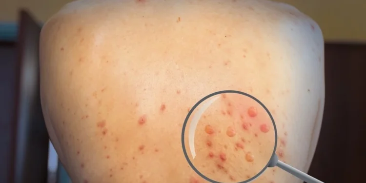 இலங்கையில் குரங்குக் காய்ச்சல் தொற்றுநோய்க்கான ஆரம்பம் அல்ல – சுகாதார அமைச்சு விளக்கம்!