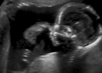 கருவில் இருந்த சிசுவுக்கு மூளை அறுவை சிகிச்சை – அமெரிக்க மருத்துவர்கள் சாதனை